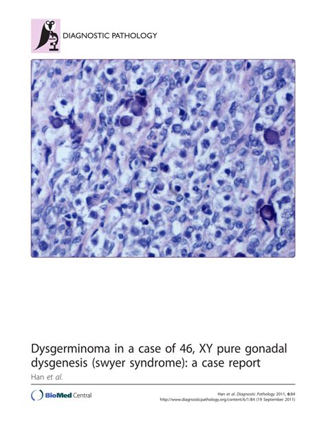 pdf dysgerminoma in a case of 46 xy pure gonadal dysgenesis swyer syndrome a case report