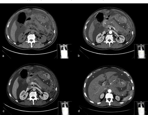 Figure 2 From Adult Abdominal Burkitt Lymphoma With Isolated Peritoneal