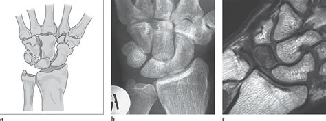 30 Osteonecrosis Of The Hand Skeleton Radiology Key