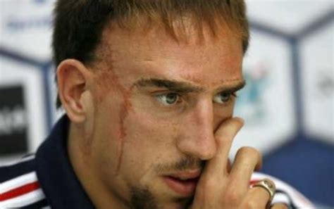 How Franck Ribery got his scars - FootyBlog.net