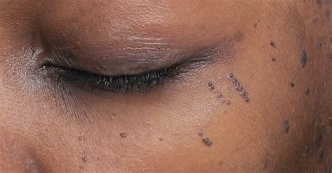 Dermatosis Papulosa Nigra A Common But Often Misdiagnosed Skin
