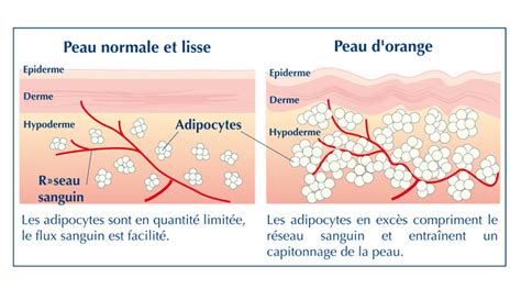 Comprendre Et Traiter La Cellulite Ou Peau Dorange