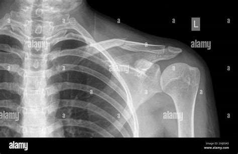 Fractured Collar Bone X Ray Stock Photo Alamy