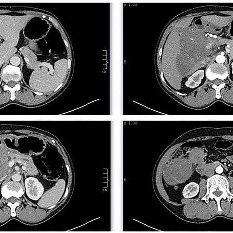 Computed Tomography Ct Scan Showed A Retroperitoneal Soft Tissue