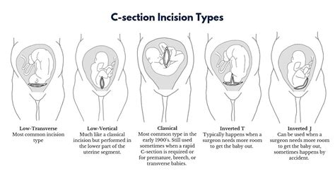 C Section Transverse Baby Babycenter
