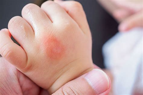 5 Common Types Of Skin Allergies In Babies And Treatment