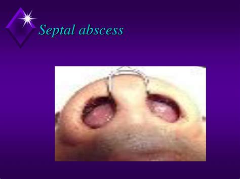 Ppt Nasal Obstruction Blocked Nose Powerpoint Presentation Free