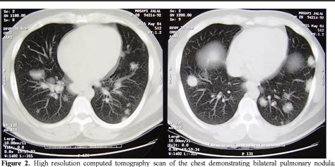 Pdf Multiple Bilateral Pulmonary Nodules Masquerading As Pulmonary