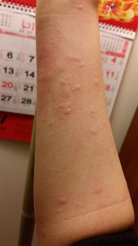 Skin Concern Allergic Reaction Itchy Bumps All Over Body Buku