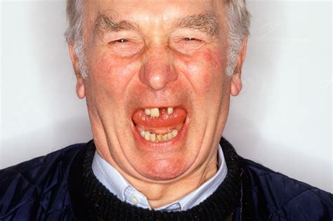 Image Result For Bad British Teeth Pictures Зубы Здоровье
