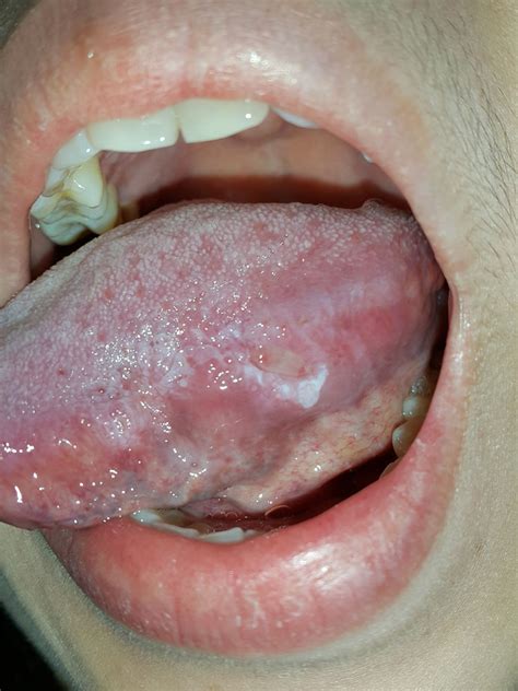 Tongue Cancer How Much Do You Know 口腔溃疡或口疮还是舌癌 Ulser Mulut Yang Tak