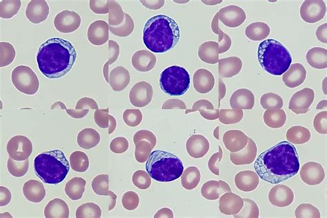 Chronic Lymphocytic Leukemia