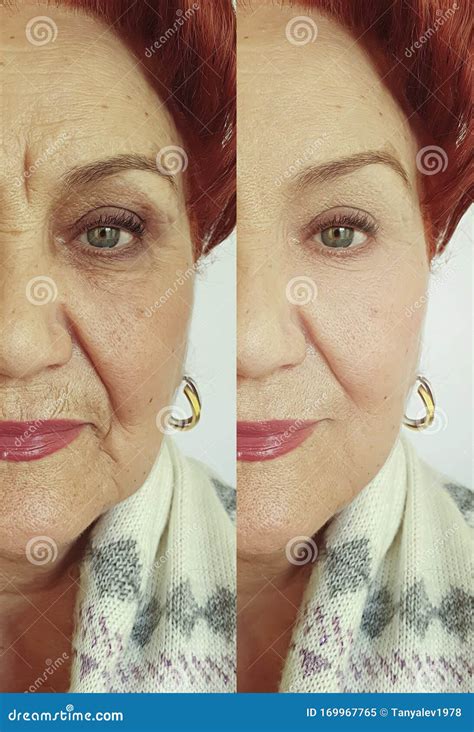 Face Old Woman Wrinkles Result Before And After Revitalization