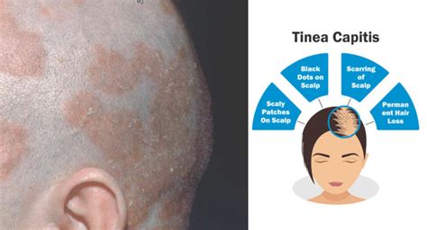 Treatment Of Tinea Capitis And Tinea Barbae Fungus Therapy