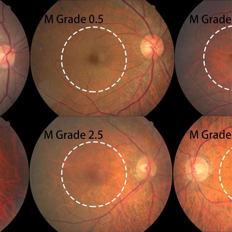 Subregions And Feature Photographs Of Macular Fundus Tessellation As