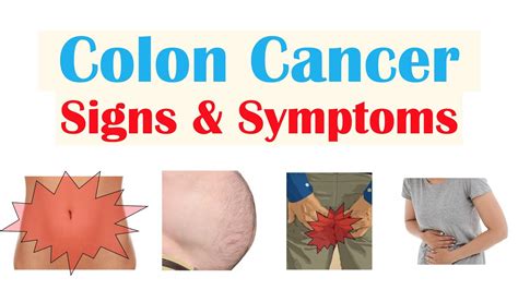 Colon Cancer Crc Signs And Symptoms And Why They Occur Youtube