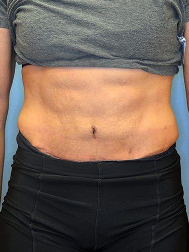 Tummy Tuck Before And After Photos