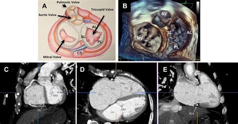 Multimodality Imaging Of The Tricuspid Valve With Implication For