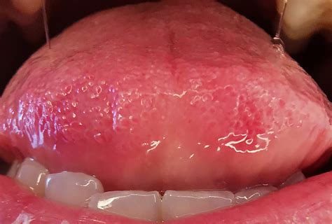 Hilfe Krebs Oder Pilz Was Ist Das Auf Meiner Zunge Denta Beaute
