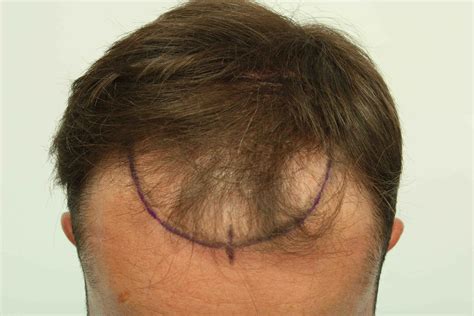 Post Op Recovery Photographs 2 Weeks After FUE Hair Transplant Procedure