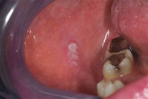 Oral Pathology White Lesion And Squamous Cell Carcinoma Flashcards