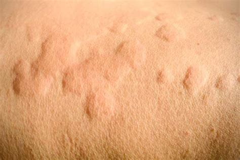 3 Women Living With Chronic Hives Chronic Hives Urticaria Hives