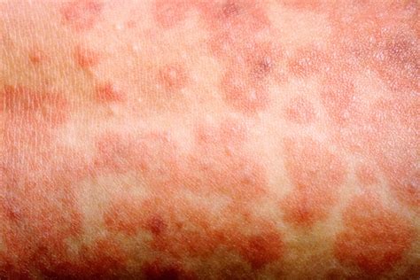 Measles Symptoms Causes And Vaccination Healthdirect