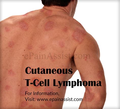 Cutaneous T Cell Lymphoma Face