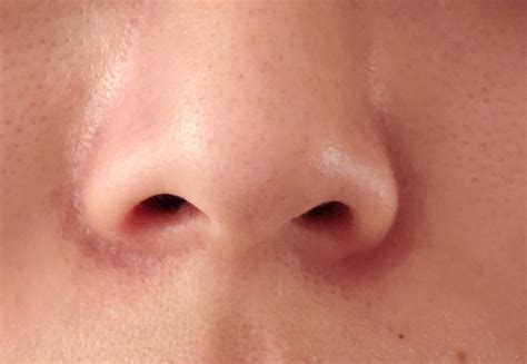 Skin Concerns Any Tips For Getting Rid Of Persistent Redness At Base