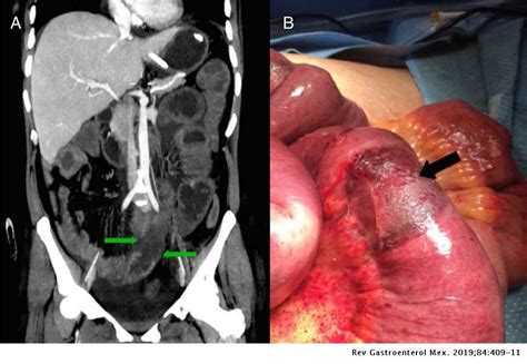 Supporting imaging studies, histopathology, and cultures of the involved tissue. Mucormicosis gastrointestinal: causa atípica de dolor ...