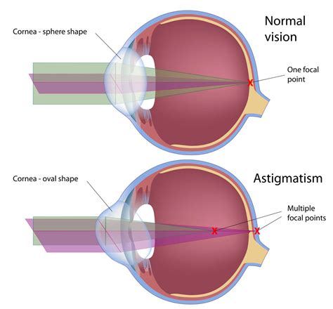 Atropine For The Treatment Of Near Sightedness Myopia In Children