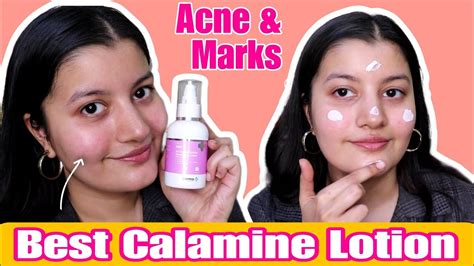I Used This Calamine Lotion For 7 Years For My Pimples And Marks Youtube