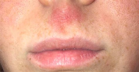Extremely Itchy And Red Burning Rash Above Upper Lip I Have Had This