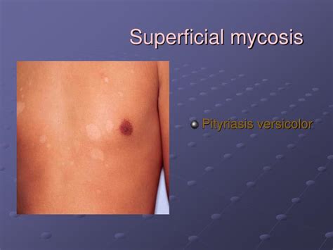 Ppt Superficial Mycosis Powerpoint Presentation Id1720076