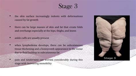 Ppt What Are The Different Stages Of Lipedema Powerpoint