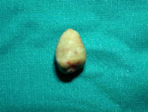 Giant Salivary Gland Calculi Gsgc Report Of Two Cases Fulltext