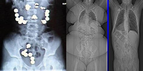 How do x ray photos work. 15 Shocking X-Rays You Won't Believe Are Real