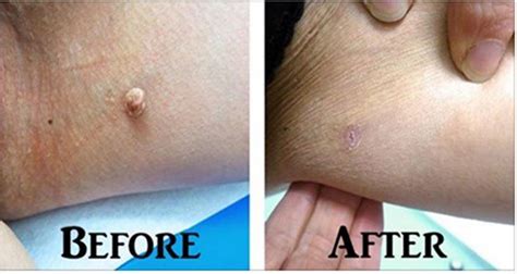 Apply This On Your Skin And Any Wart Or Fibroid Will Magically Go Away
