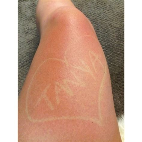 People Are Getting Sunburned On Purpose For Sunburn Tattoos