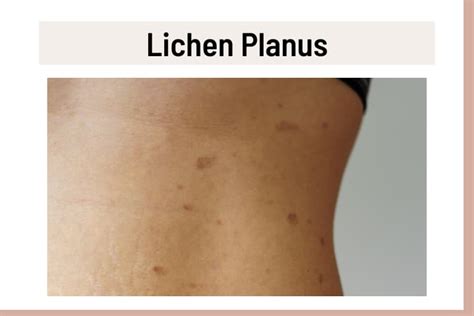 Purple Spots On Skin 9 Causes Pictures And Treatment