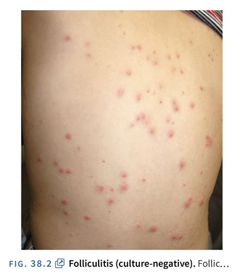 Tangs Clinical Tcm On Twitter These Red Spots Are Not Eczema They