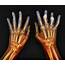 Rheumatoid Arthritis Of The Hands Photograph By Zephyr/science Photo 