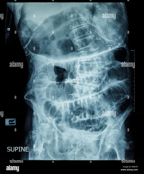 Small Bowel Obstruction Film X Ray Abdomen Supine Position Stock