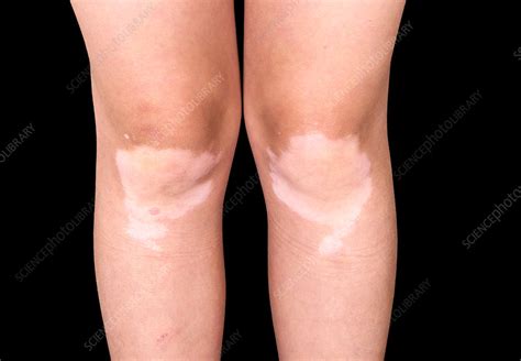Vitiligo Skin Condition Stock Image C0382276 Science Photo Library