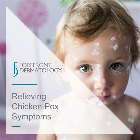 Relieving Chicken Pox Symptoms Forefront Dermatology
