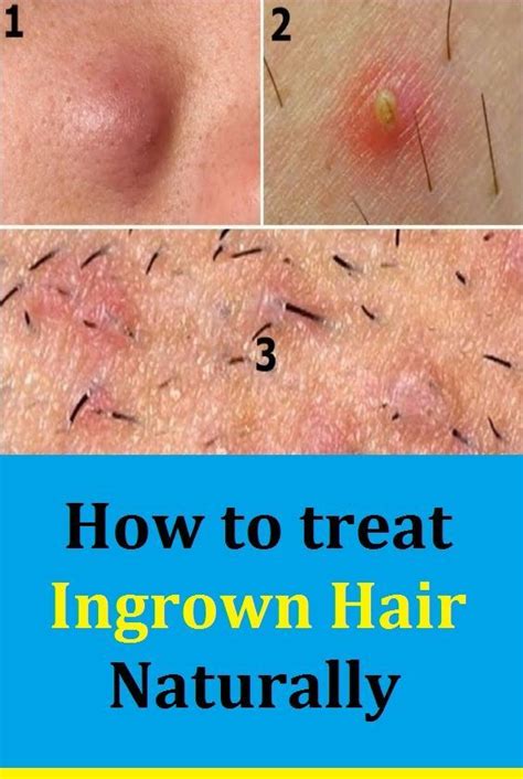How To Treat Ingrown Hair Naturally In 2020 Ingrown Hair Treat Ingrown Hair Treating Ingrown