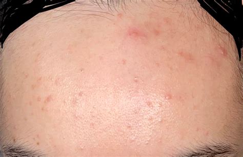 Acne Help Forehead Acne And Closed Comedones For 5years Tried Nearly