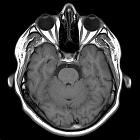 Pituitary Gland Cyst Image