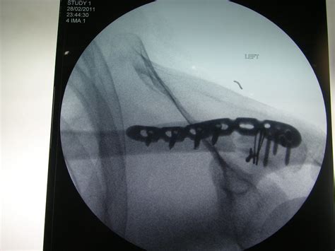 Surgery For Broken Bones 🩺singapore Sports And Orthopaedic Surgeon