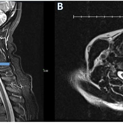 T2 Weighted Sagittal A And Axial B Cervical Spine Mri Reveals A 4